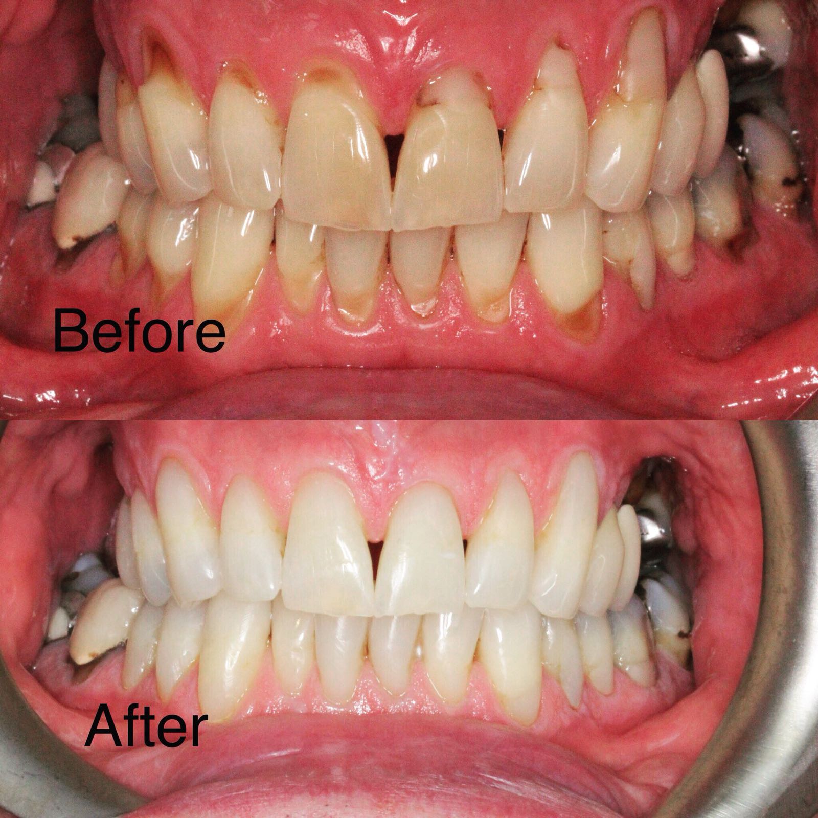 Teeth Whitening Gallery Brunner Court Dental & Implant Practice